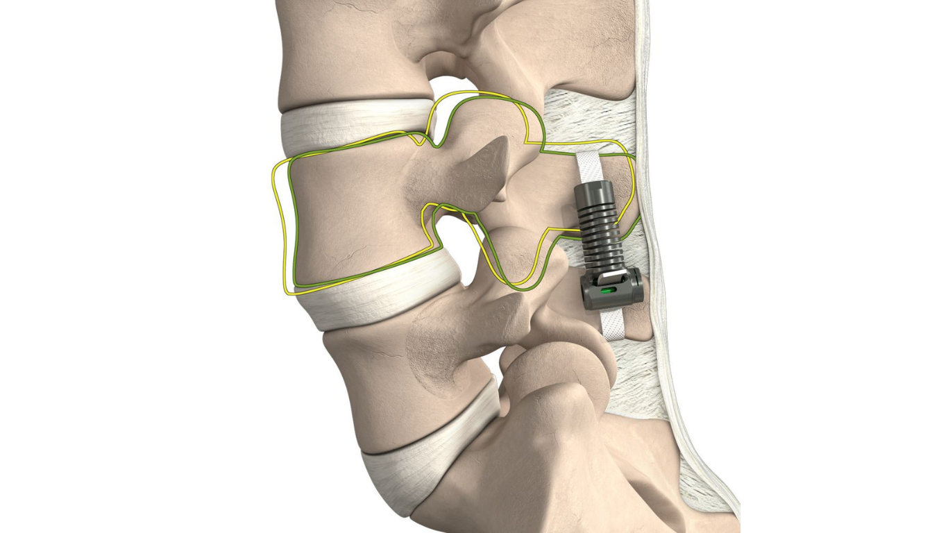 LimiFlex Dynamic Sagittal Tether Outperforms TLIF in FDA Trial
