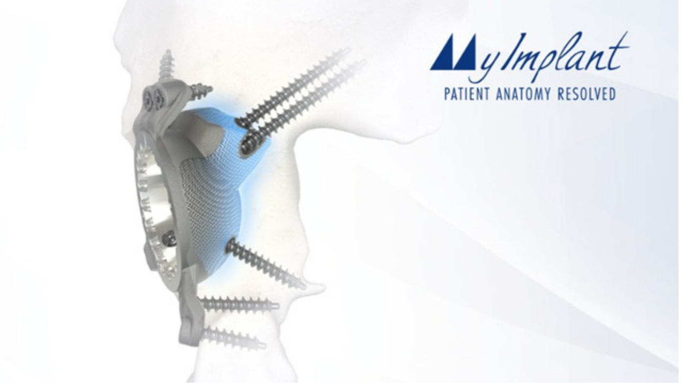 Medacta Extends MyImplant Platform to Complex Hip Reconstruction