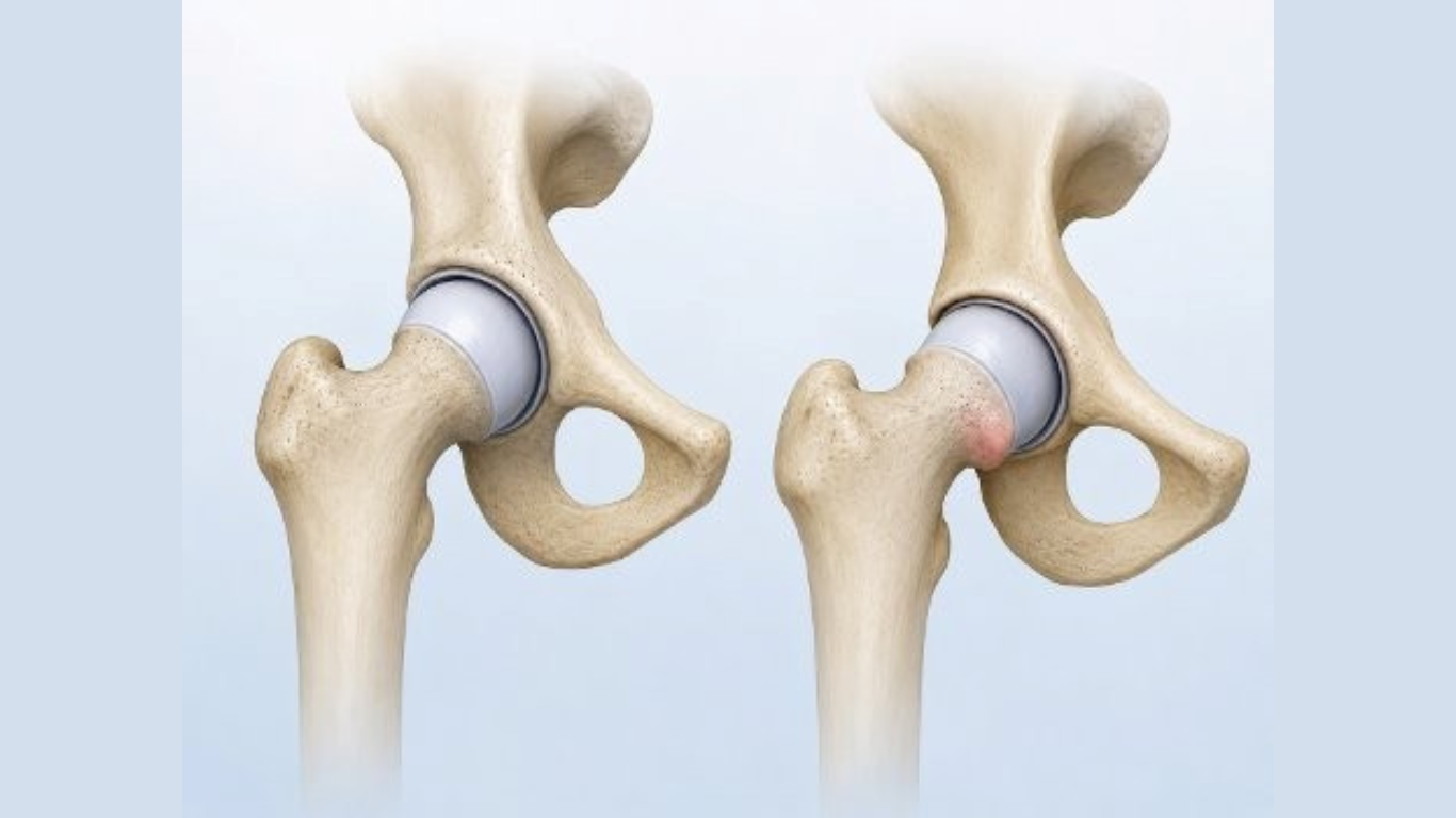 What Angle Triggers Symptomatic Femoroacetabular Impingement?