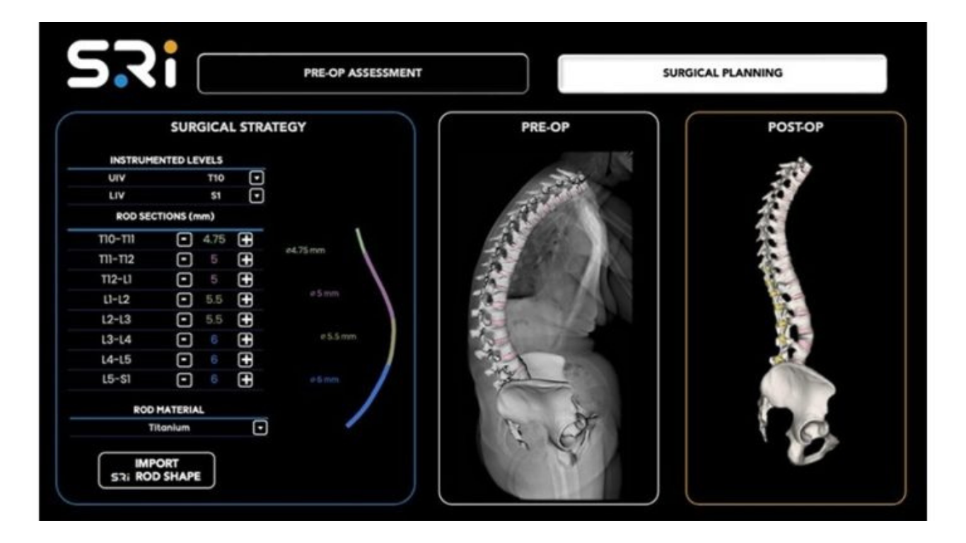 Spinal Resources, Inc. Awarded Second U.S. Patent for Multi-Diameter Spinal Fixation Rod, Establishing a Layered IP Position